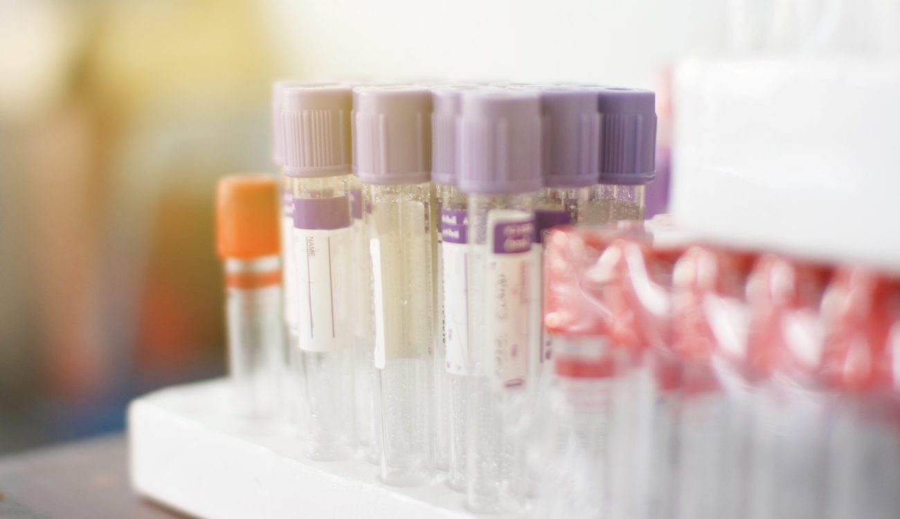 Hematology blood analysis report with lavender color sample collection tubes.blood tubes with labels for proper identification and background hand of laboratory technician